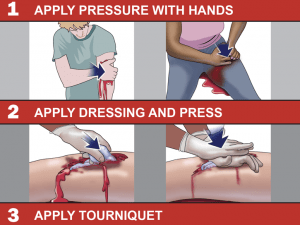 Steps to stop the bleed: 1. Apply pressure with hands, 2. Apply dressing and press, 3. Apply tourniquet